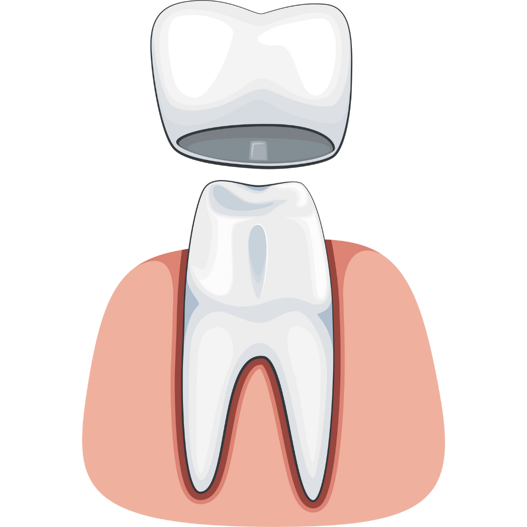 Dental Implant