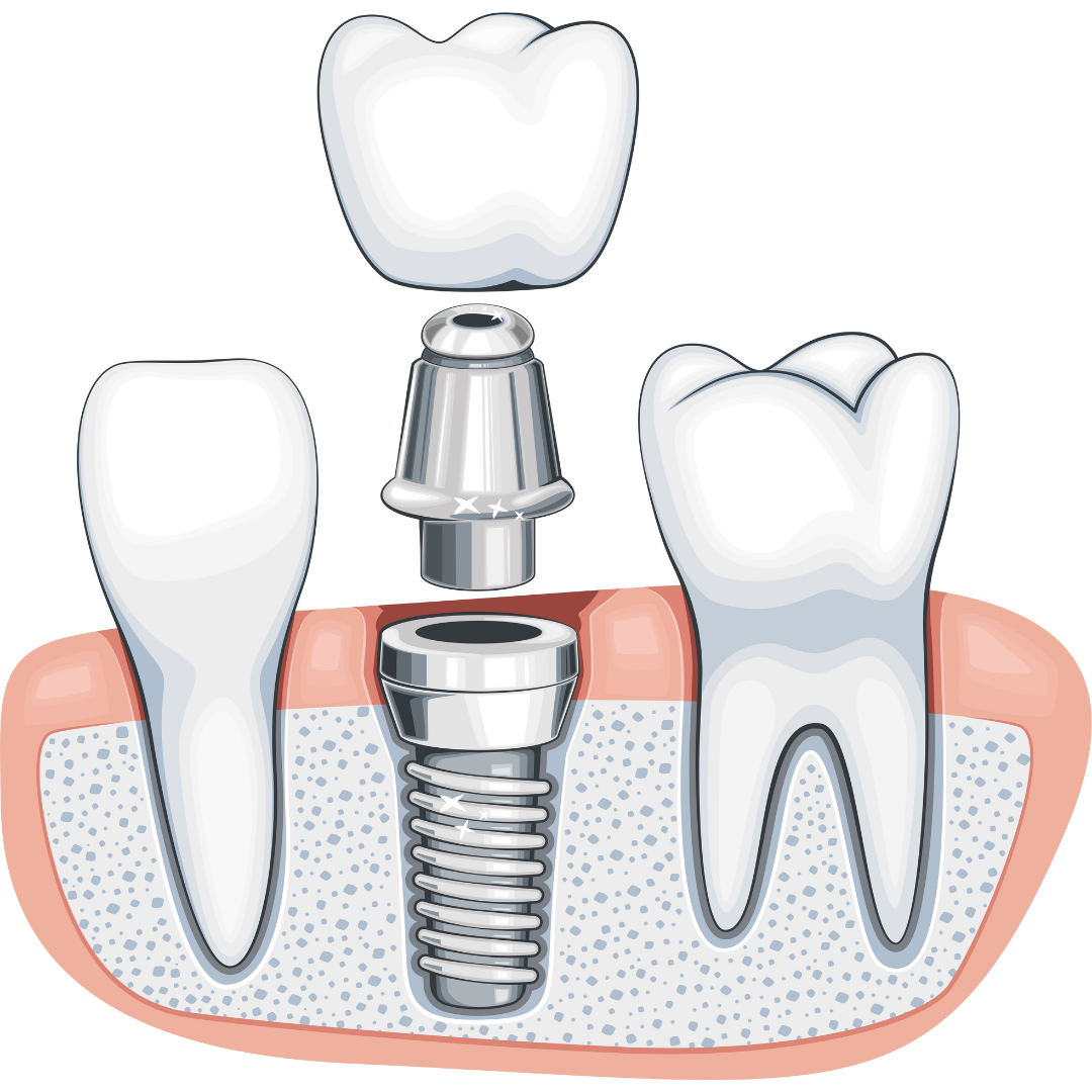 Dental Implant