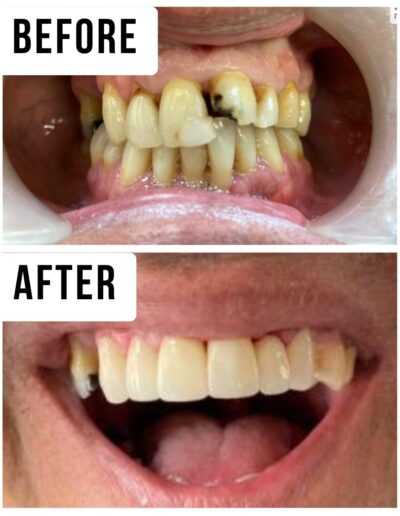 Implants and Crowns