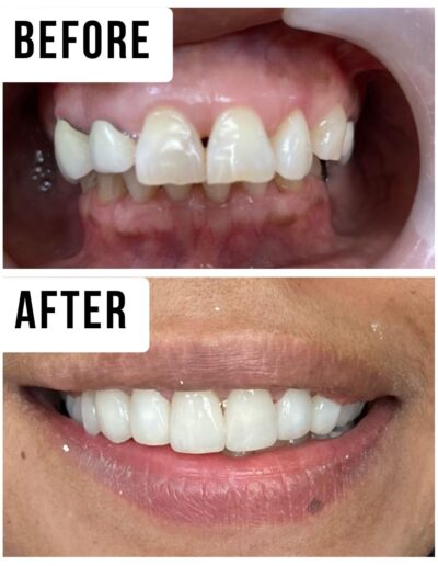 Crowns and Veneers