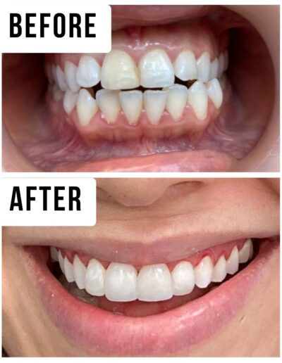 Veneers and Whitening
