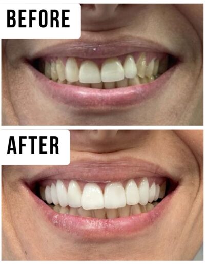 Veneers and Whitening