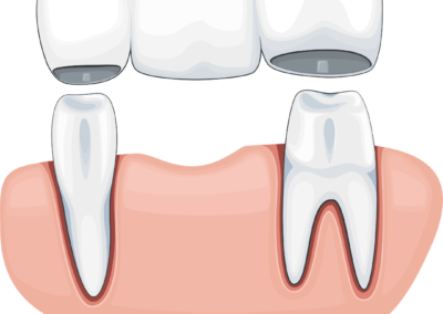 Dental Bridges