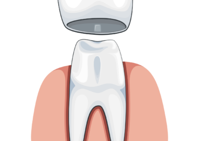 Dental Crowns
