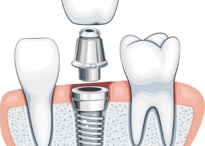 Dental Implants