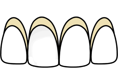 Dental Veneers